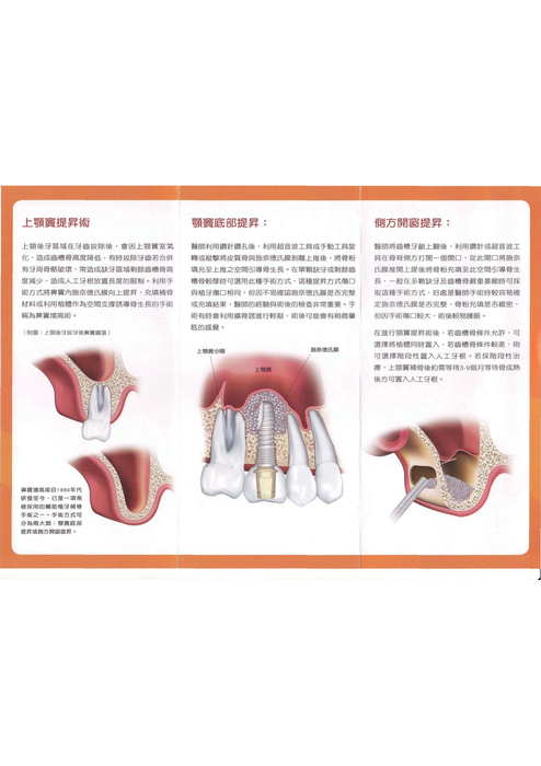 植牙小折系列_web 植牙小折系列_web
